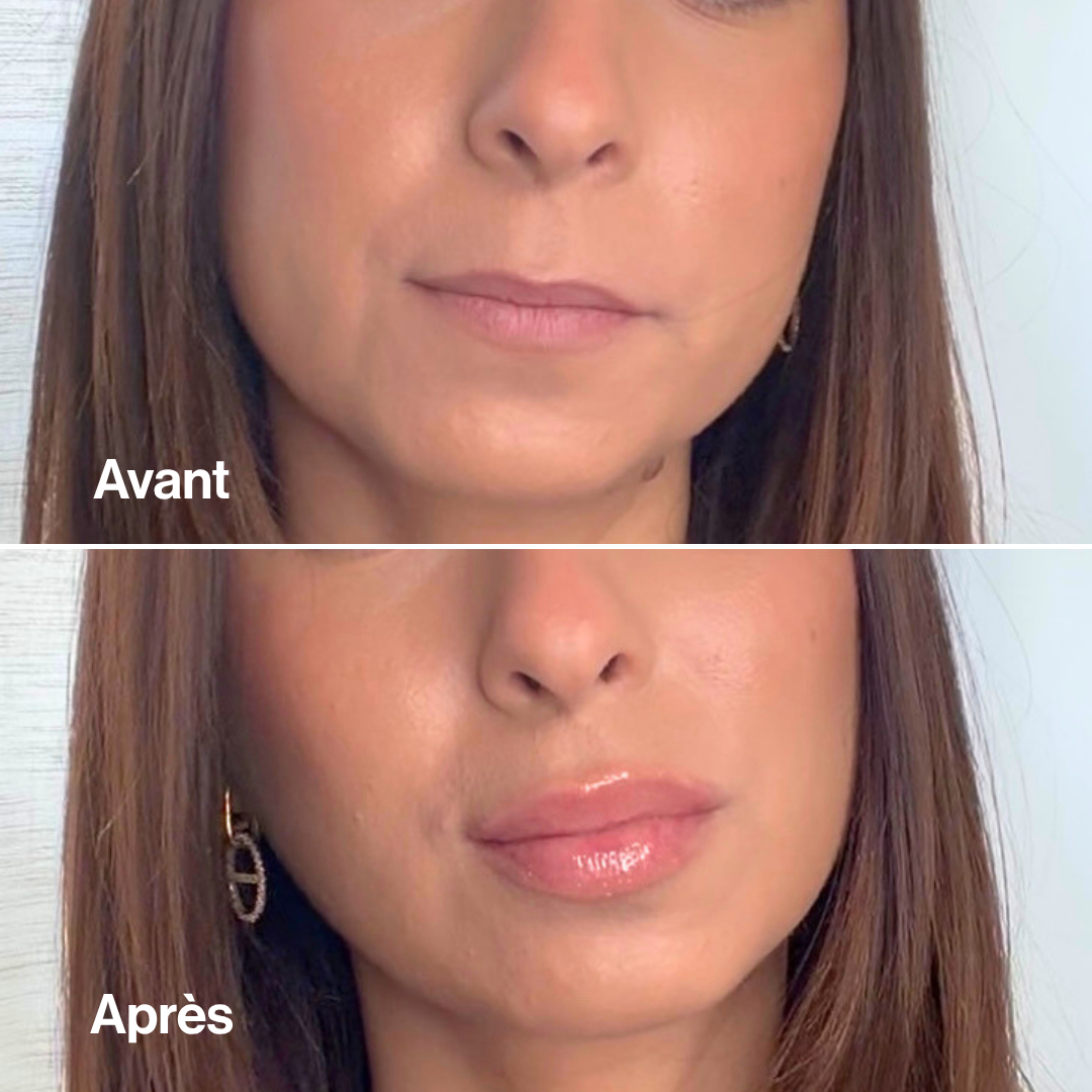 Lip Volume Extrême